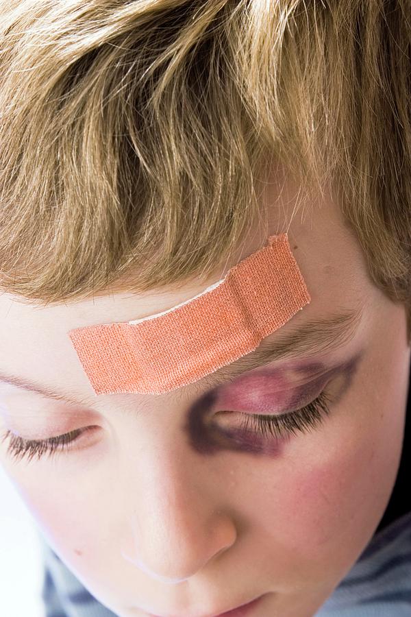 Head Injury And Black Eye Photograph by Claire Deprez/reporters/science