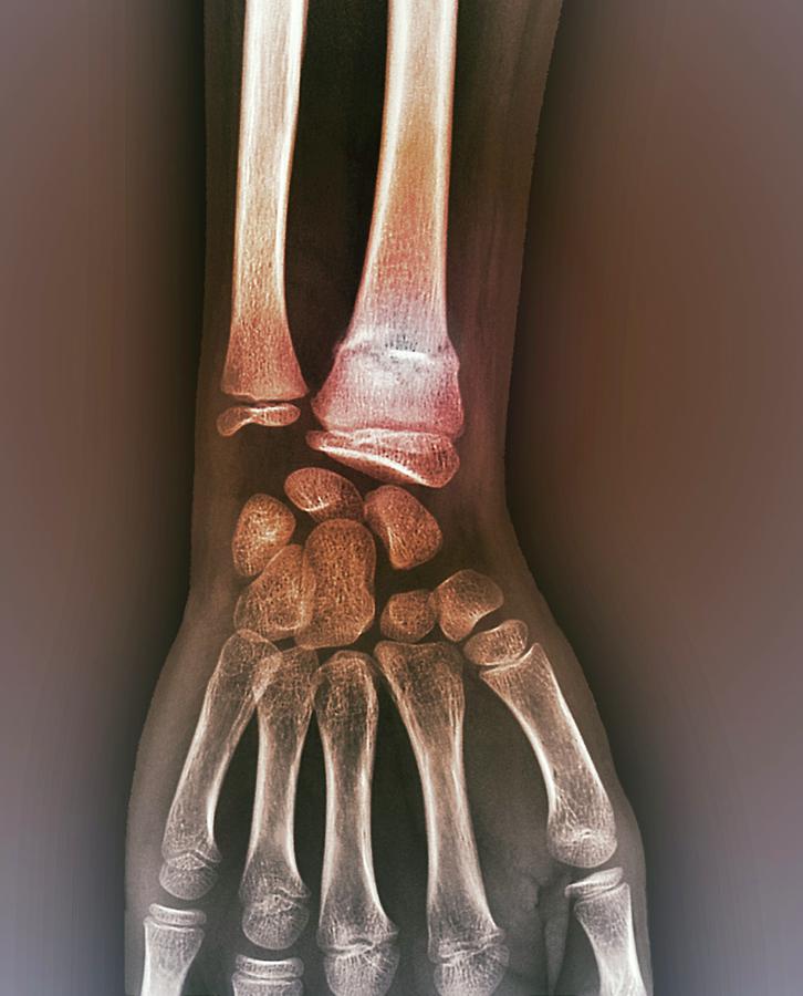Healed Arm Bone Fracture Photograph by Zephyr/science Photo Library