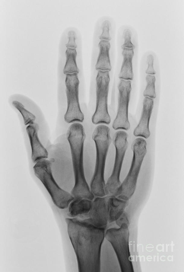 Healthy Hand X-ray Photograph by Scott Camazine