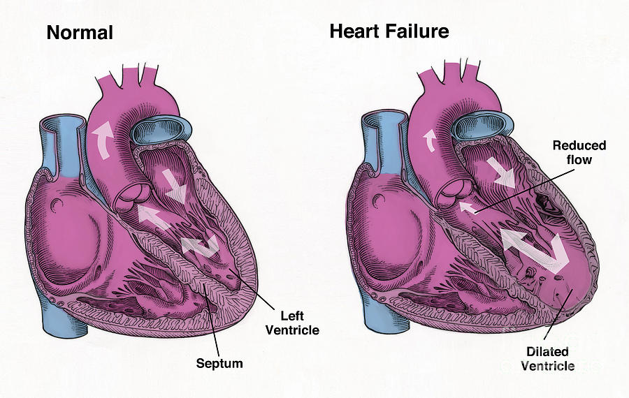 Healthy Heart Vs. Heart Failure Photograph by Spencer Sutton