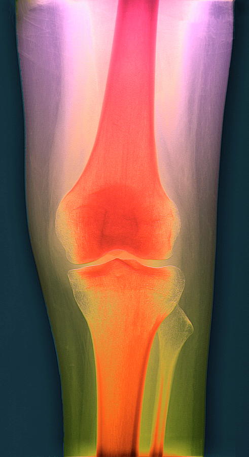 Healthy Knee Photograph by Zephyr/science Photo Library