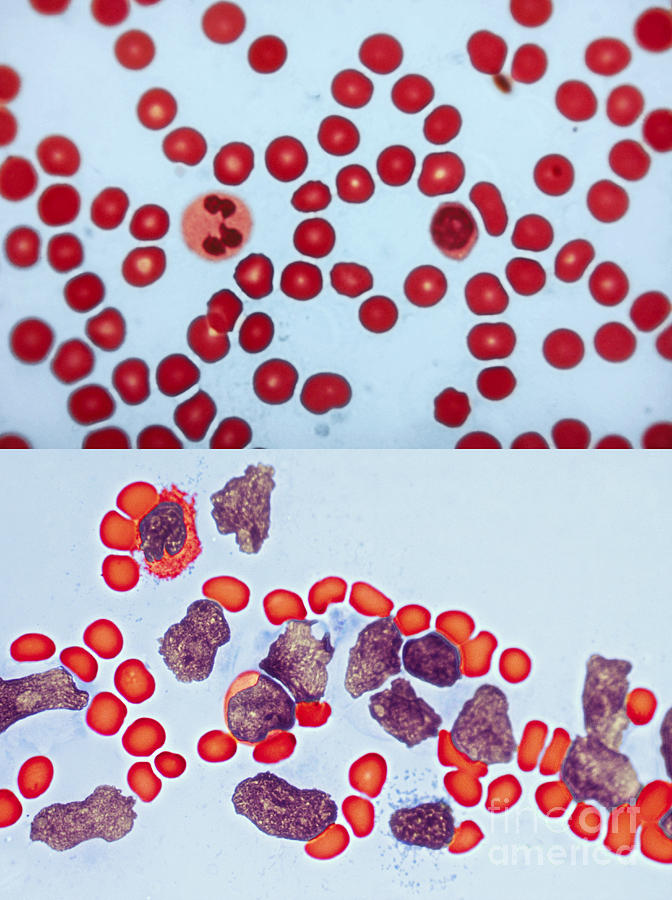 Healthy  Leukemia Blood Comparison Photograph by Spencer Sutton