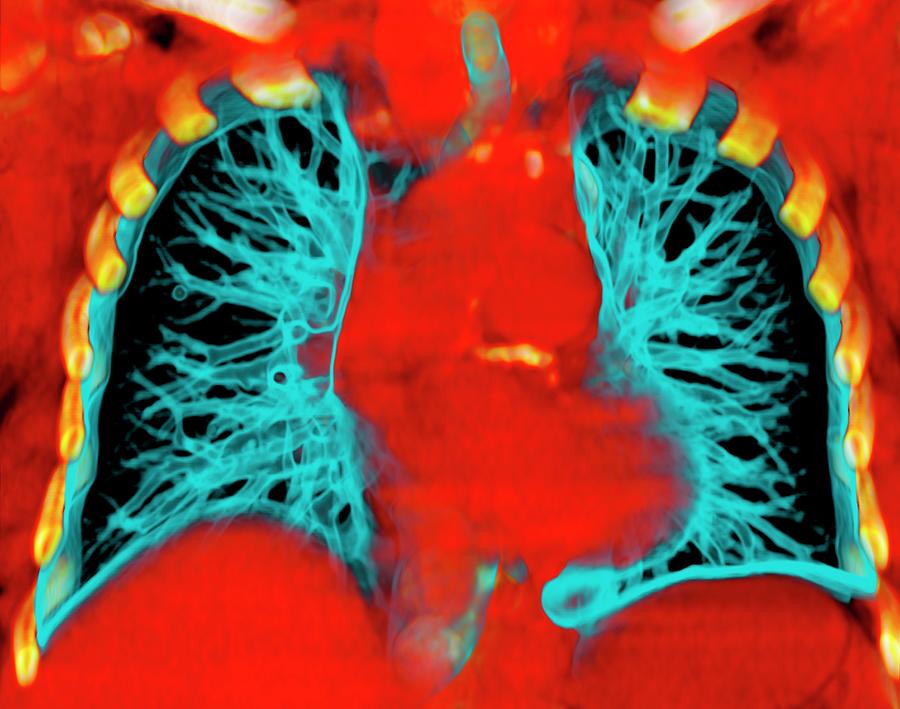 Healthy Lungs Photograph By Du Cane Medical Imaging Ltd - Pixels