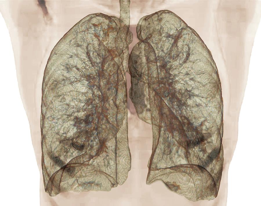 Healthy Lungs Photograph By Zephyrscience Photo Library Pixels 0696