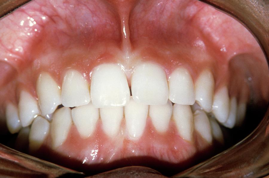 Adult Photograph - Healthy Teeth by Dr. J.p. Casteyde - Cnri