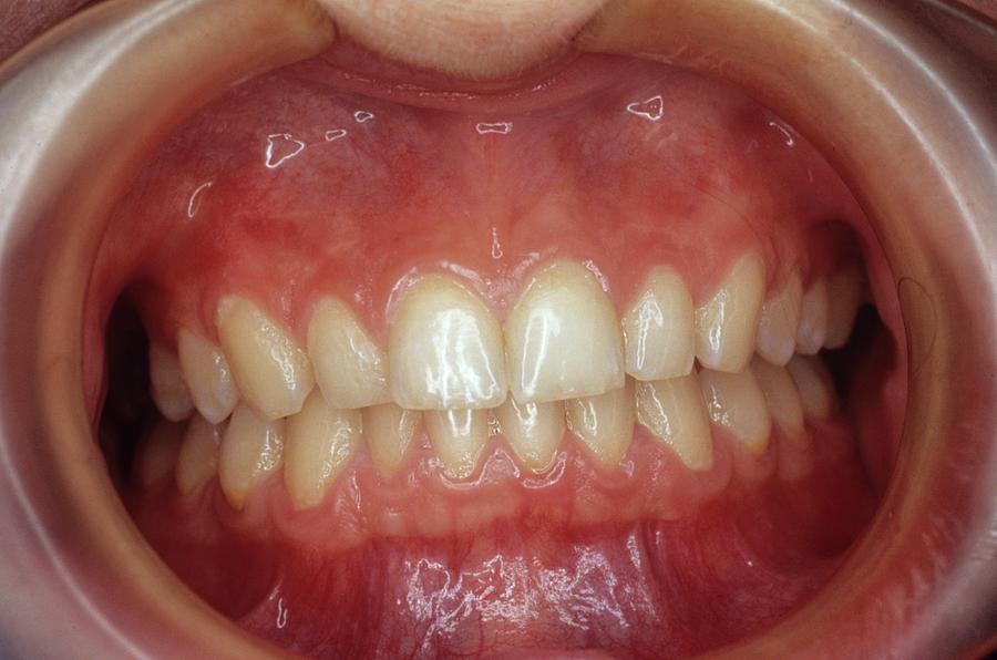 Healthy Teeth Photograph by Dr. M. Gaillard - Cnri