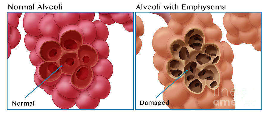 Healthy Vs. Emphysematous Alveoli Photograph by Monica Schroeder