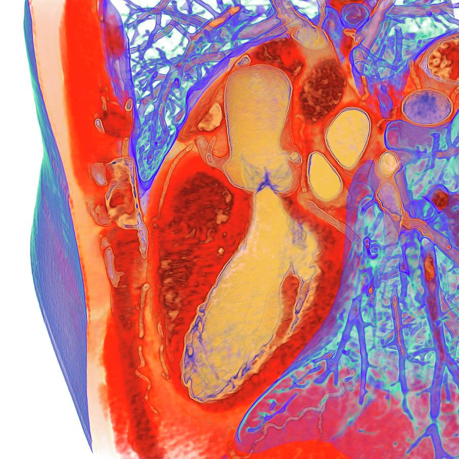 Heart And Left Ventricle Photograph by K H Fung/science Photo Library