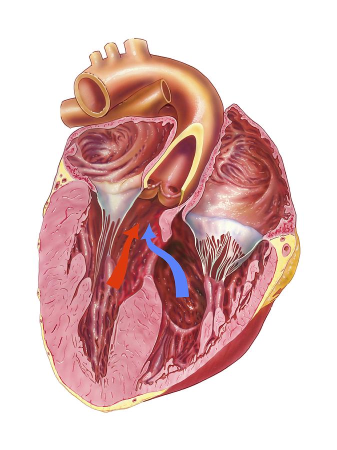 Heart chamber wall defect, artwork Photograph by Science Photo Library