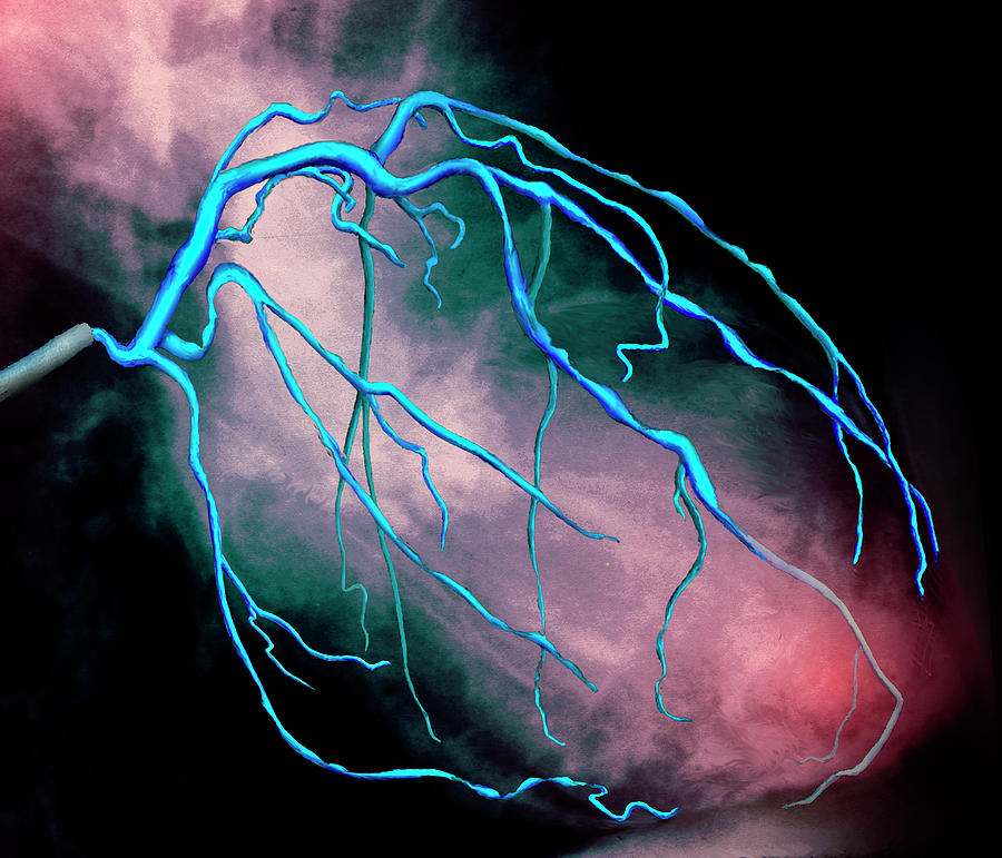 Heart Disease Photograph By Zephyr/science Photo Library