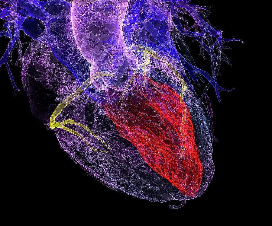 Coronary Artery Disease Photograph - Heart In Coronary Artery Disease by K H Fung/science Photo Library