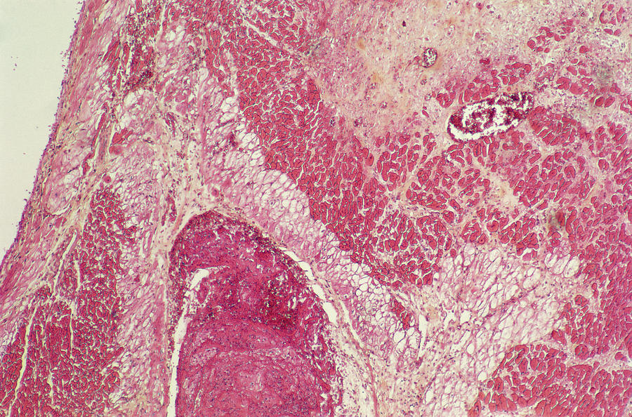 5 death of heart muscle tissue