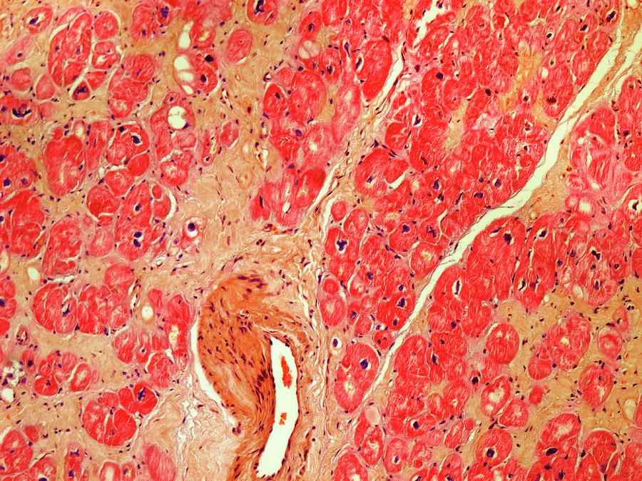 Heart Tissue Death Photograph by Steve Gschmeissner/science Photo ...