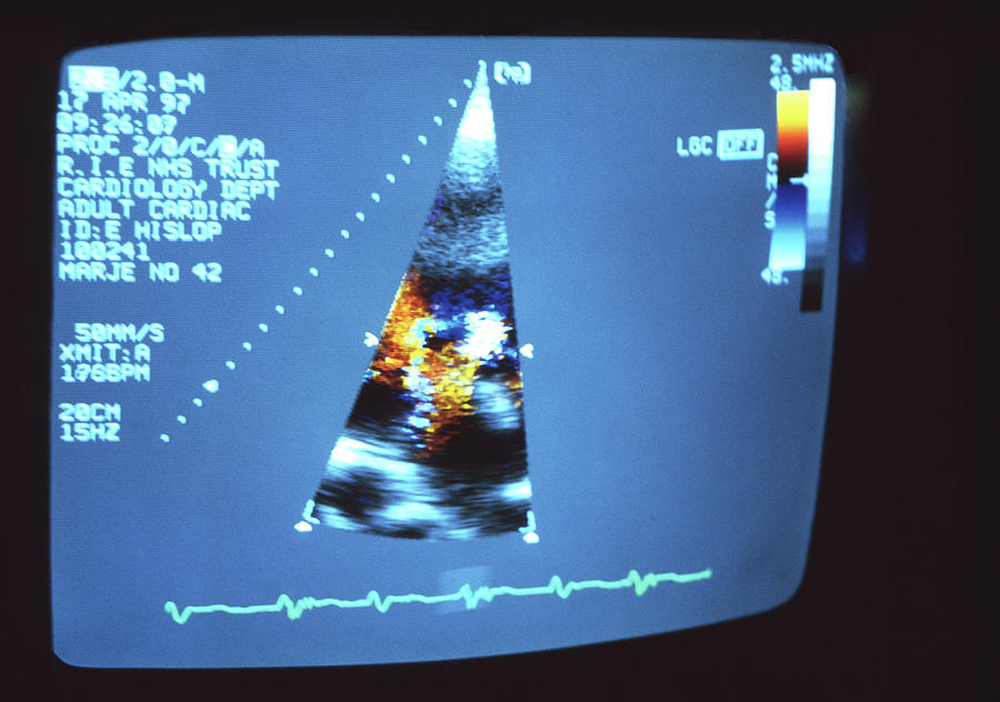 Heart Ultrasound Scan by Antonia Reeve/science Photo Library