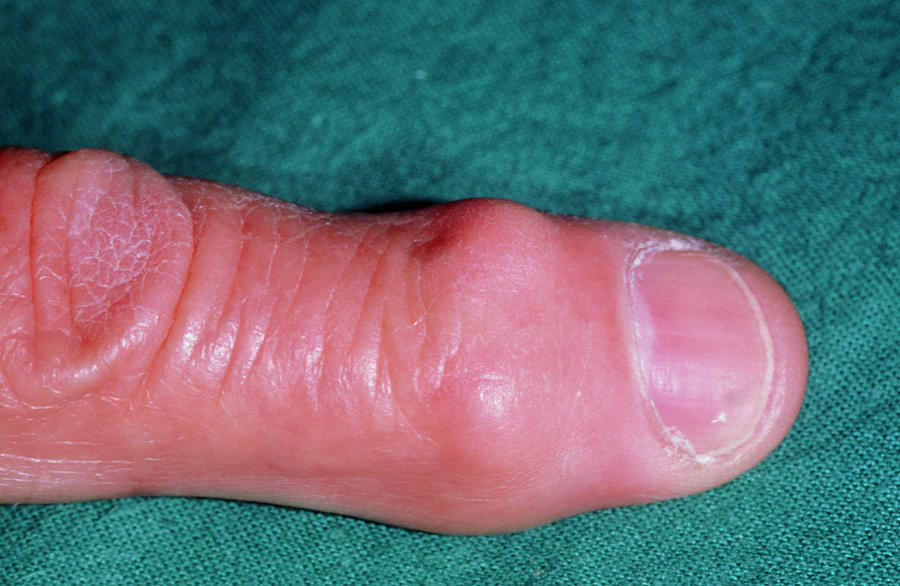 Heberden's Node On Finger In Osteoarthritis Photograph by Dr P. Marazzi ...
