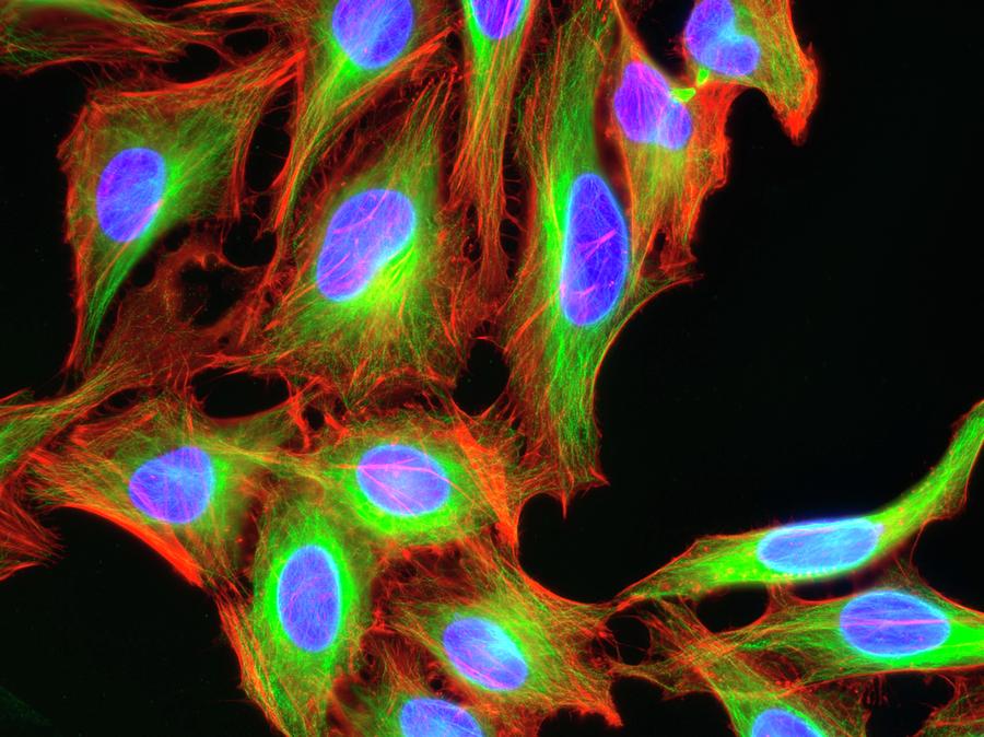 Hela Cervical Cancer Cells Photograph by Kevin Mackenzie / University Of Aberdeen / Science Photo Library