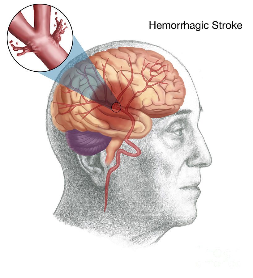 Hemorrhagic Stroke Photograph By Spencer Sutton