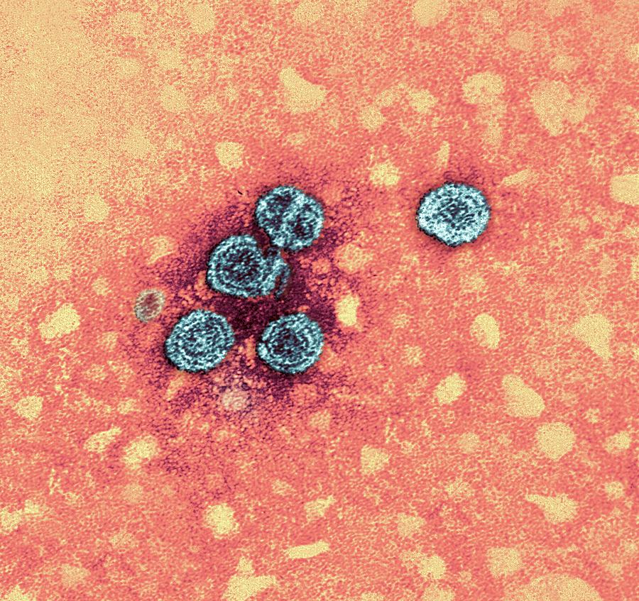 Hepatitis B Virus Particles Photograph By Ami Images/dr. Erskine Palmer ...