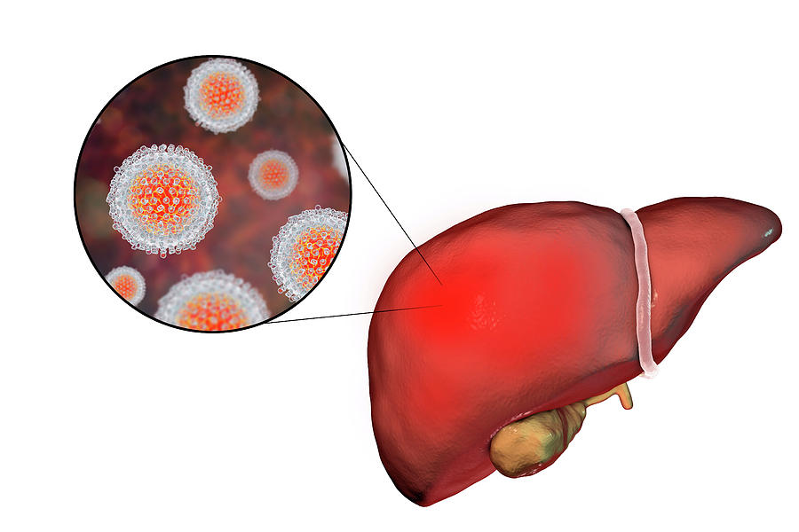 Гепатит д картинки