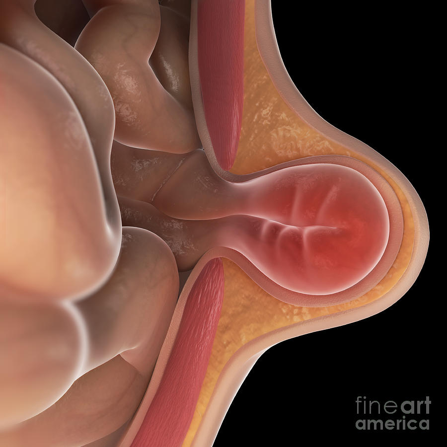 Hernia Cross-section Photograph by Science Picture Co