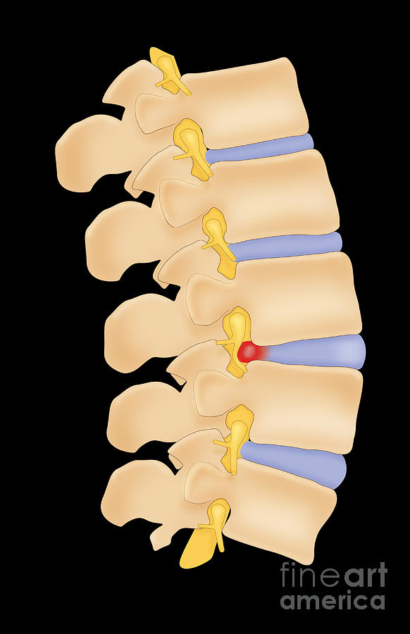 Herniated Disk Photograph by Photo Researchers, Inc. - Fine Art America