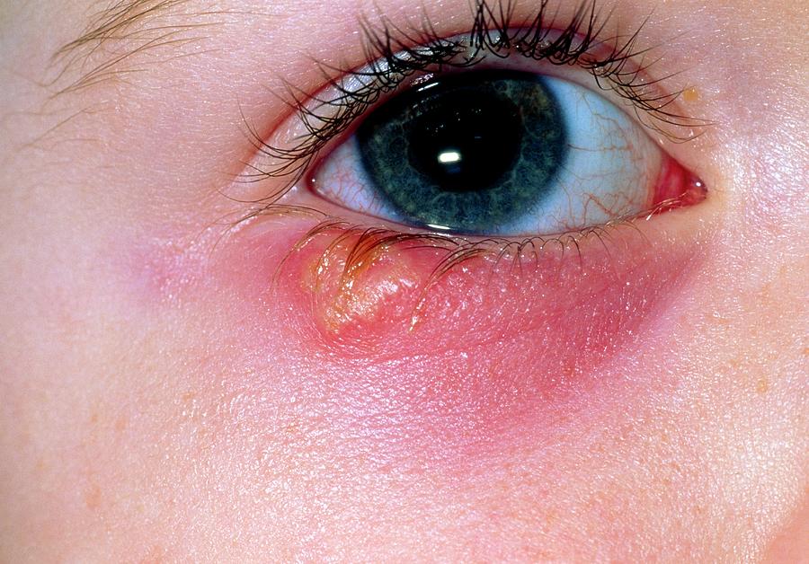 herpes-simplex-blister-below-eye-of-young-girl-photograph-by-dr-p