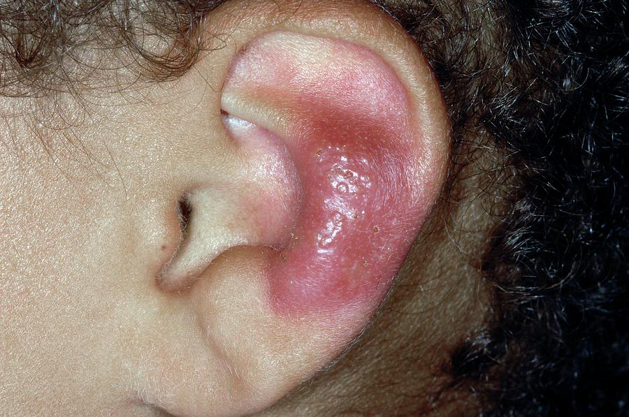 Herpes Simplex Lesion On The Ear Dr P Marazziscience Photo Library 