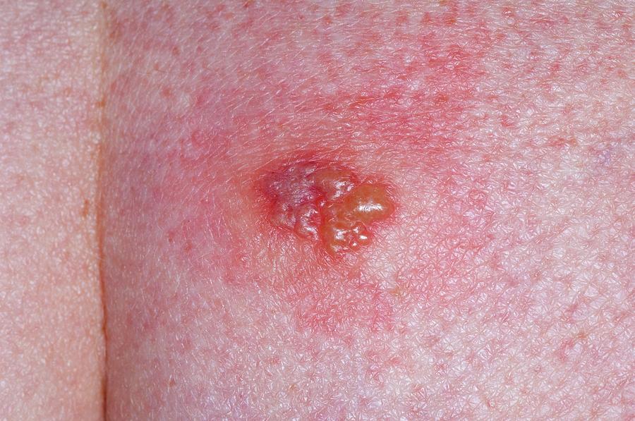 Herpes Simplex Lesion On The Skin Dr P Marazziscience Photo Library 