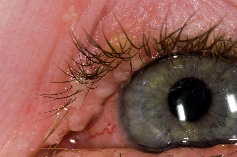 Herpes Simplex Lesions On Eyelid Photograph By Dr P Marazzi science 