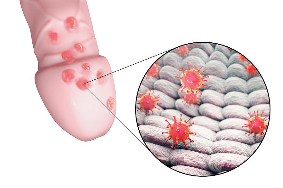 Herpes Virus And Lesions Photograph By Kateryna Kon Science Photo