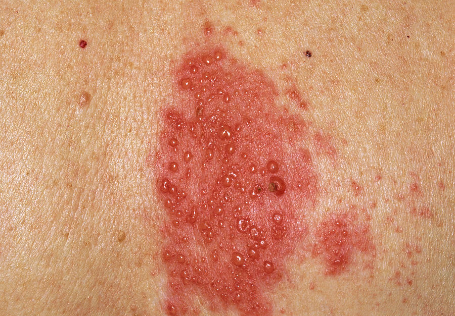 herpes-zoster-blisters-on-a-woman-s-back-photograph-by-dr-p-marazzi