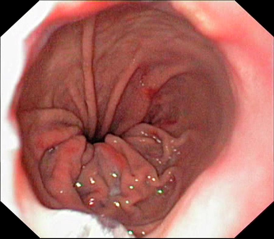 Abnormal Photograph - Hiatal Hernia And Barretts Oesophagus by Gastrolab/science Photo Library