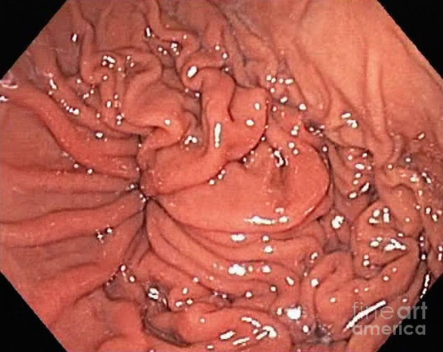 Digestive System Photograph - Hiatal Hernia, Endoscopic View by Gastrolab