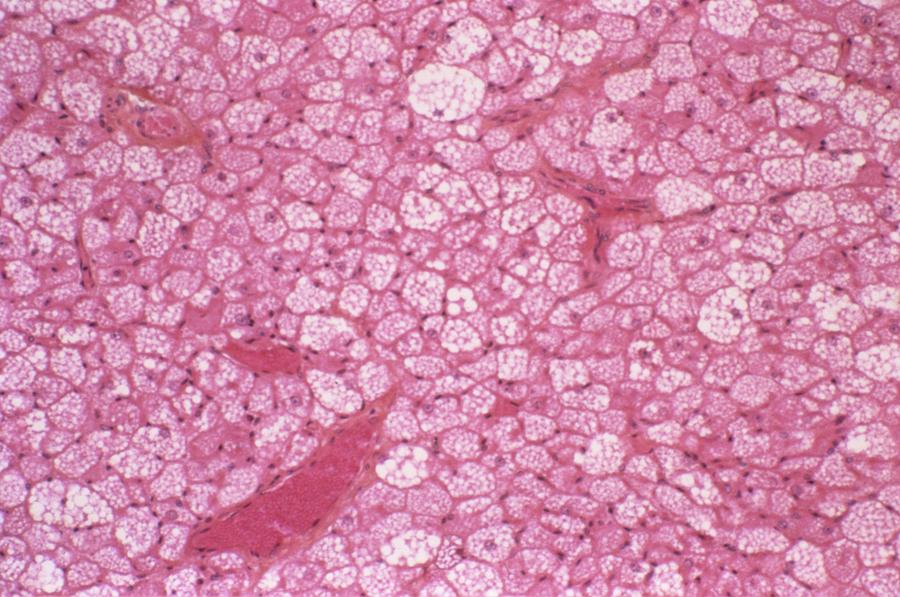 Hibernoma Photograph by Cnri Fine Art America