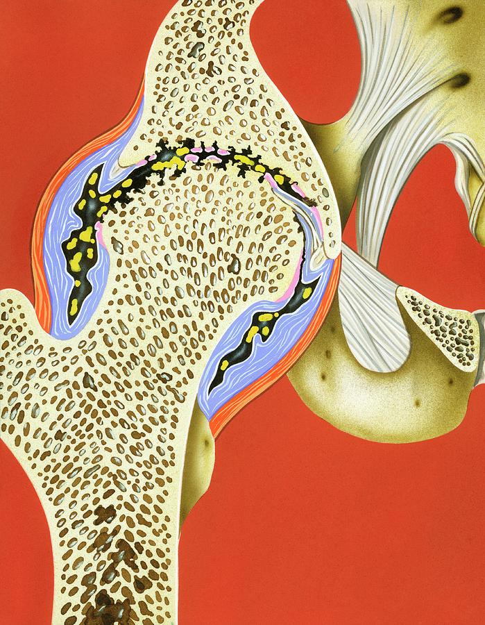 Hip Joint Cartilage Loss Photograph by Science Photo Library Biology Diagrams