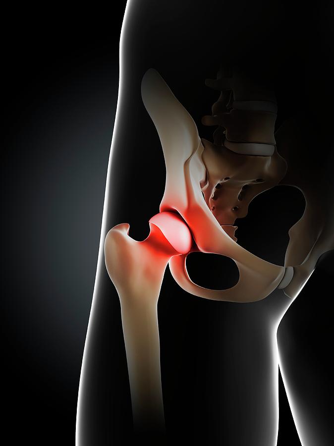 Hip Pain Photograph by Sciepro/science Photo Library