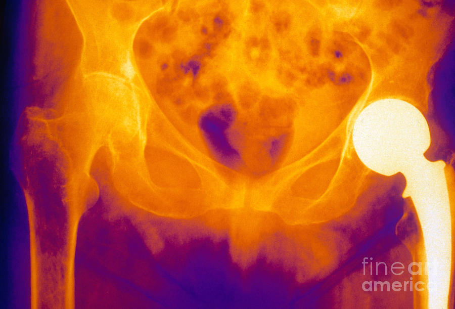 Hip Replacement And Osteoporosis, X-ray Photograph by Scott Camazine