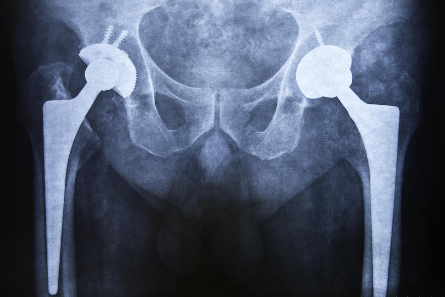 Hip replacement Photograph by Pedre