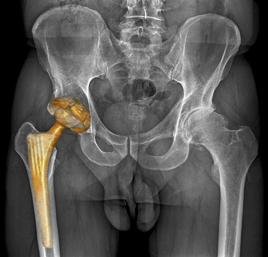 https://images.fineartamerica.com/images-medium-large-5/hip-replacement-zephyr.jpg