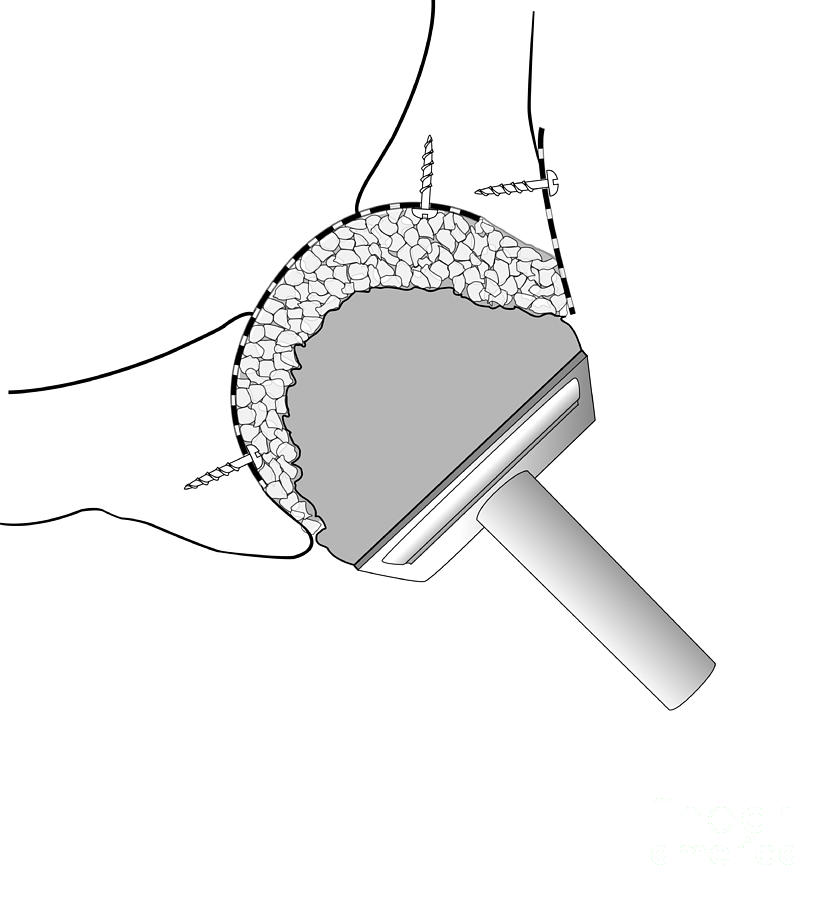 Hip Socket Bone Grafting, Diagram Photograph by D & L Graphics - Fine ...