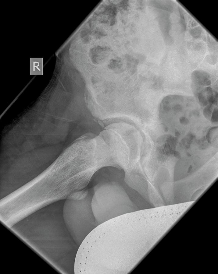 Skeleton Photograph - Hip X-ray by Photostock-israel