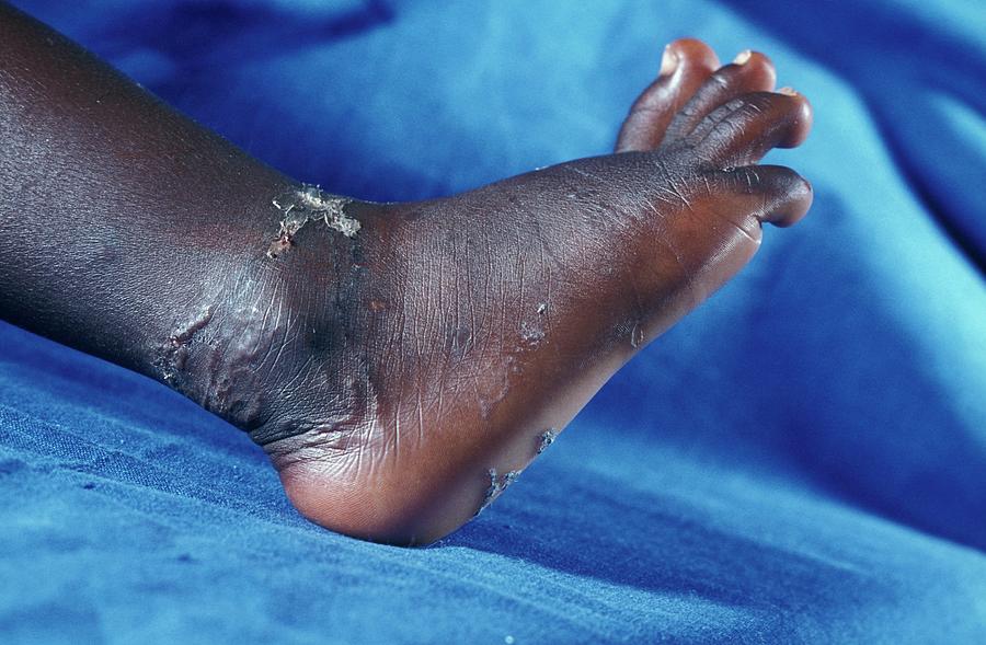 Larva Migrans Photograph - Hookworm Infection by Dr M.a. Ansary/science Photo Library