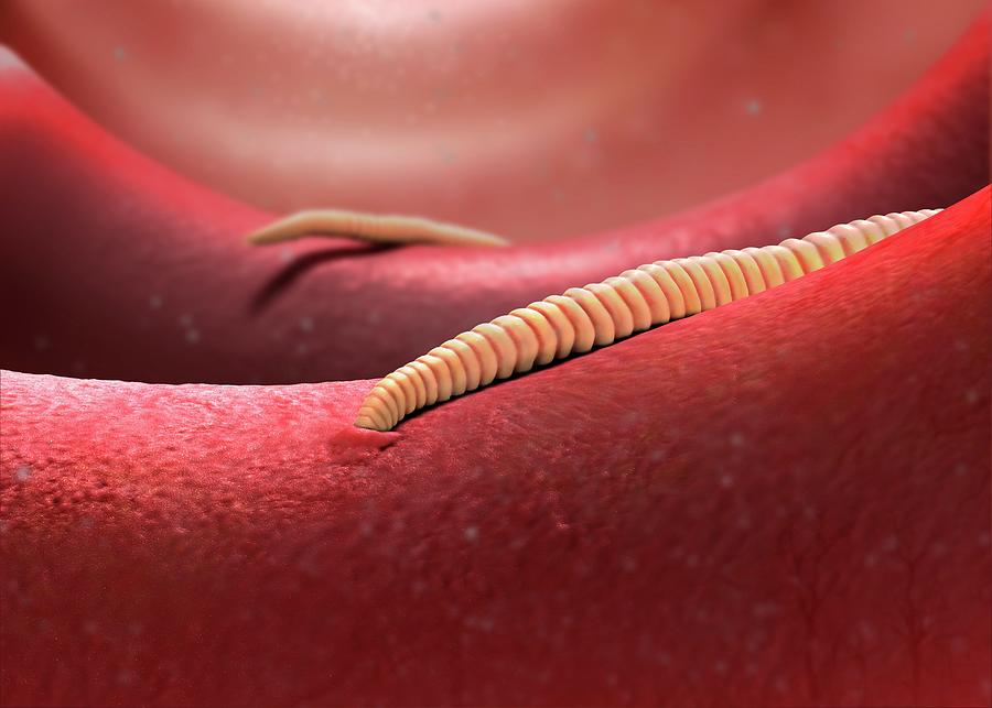 Hookworms In The Intestine Photograph by Tim Vernon / Science
