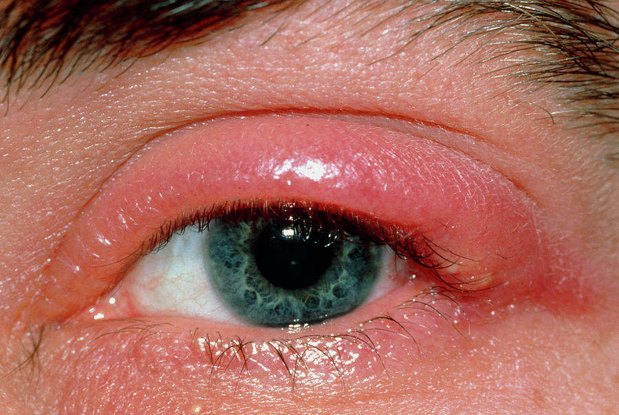 Hordeolum Or Stye On The Upper Eyelid Photograph By Science Photo Library