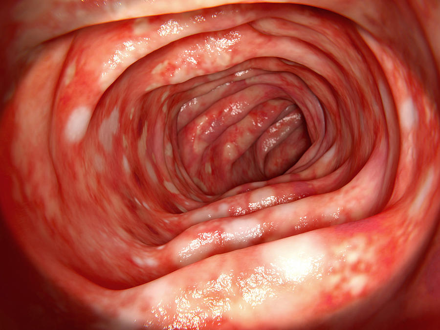 Human Colon Affected By Ulcerative Photograph by Juan Gaertner