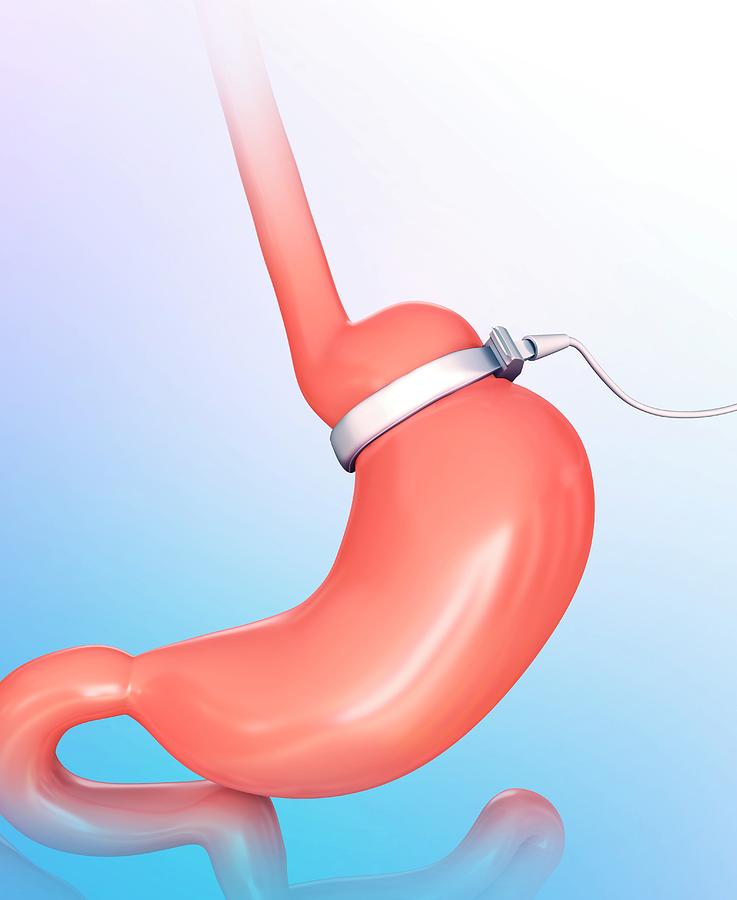 3 Dimensional Photograph - Human Gastric Band by Pixologicstudio 3 Dimensional Photograph - Human Gastric Band by Pixologicstudio