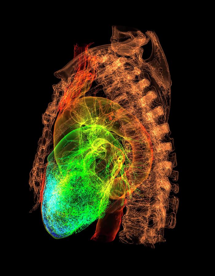 Heart Photograph - Human Heart And Spine by K H Fung/science Photo Library