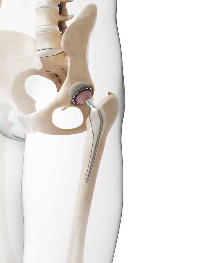 Illustration Photograph - Human Hip Replacement by Sebastian Kaulitzki