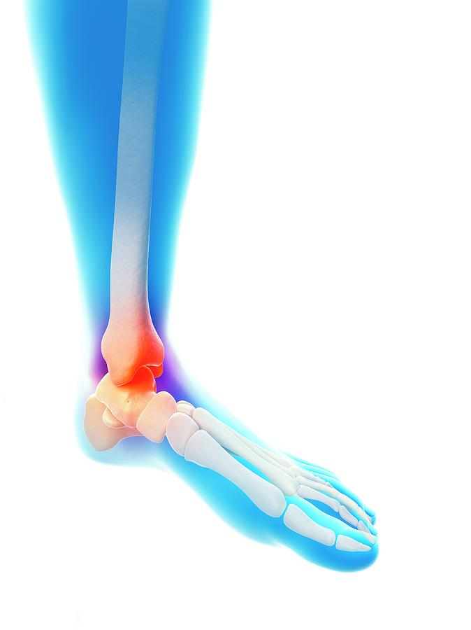Illustration Photograph - Human Inflamed Ankle by Sebastian Kaulitzki