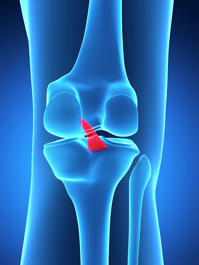 Illustration Photograph - Human Knee Ligament by Sebastian Kaulitzki